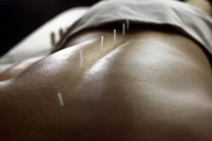 Acupuncture photo