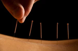 acupuncture