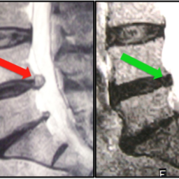 lumbar herniated disc