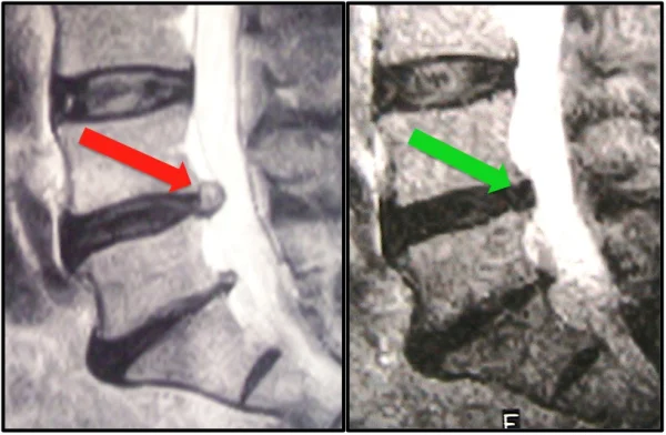 lumbar herniated disc