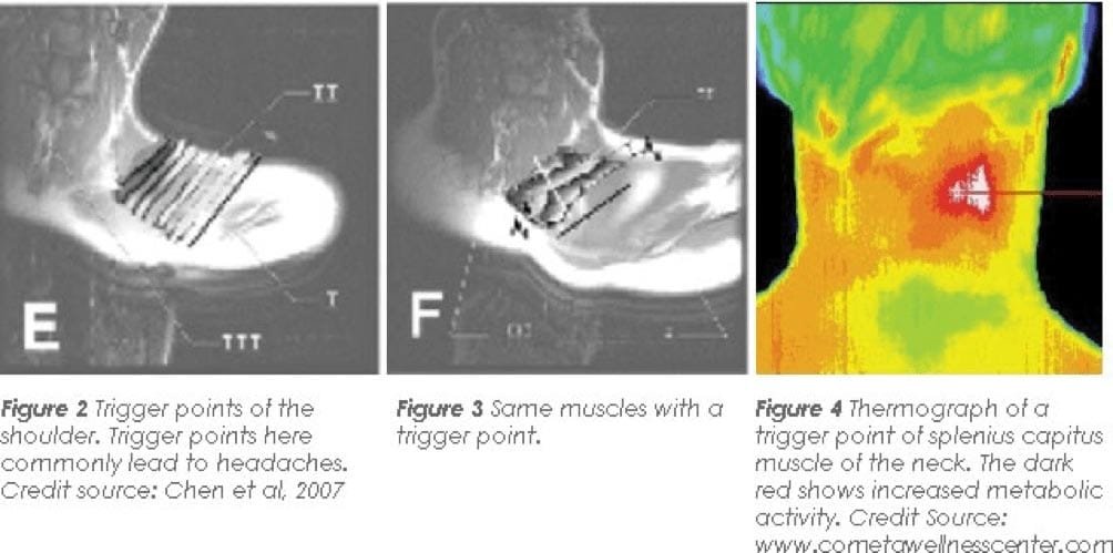 imaging of trigger points